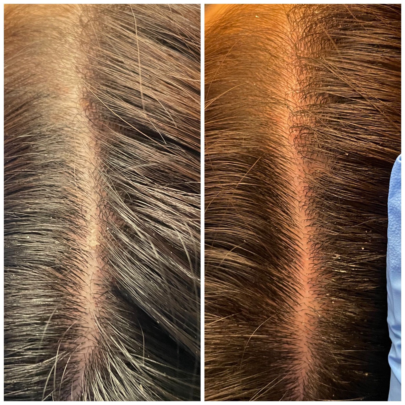 Keravive Scalp Treatment Before and After