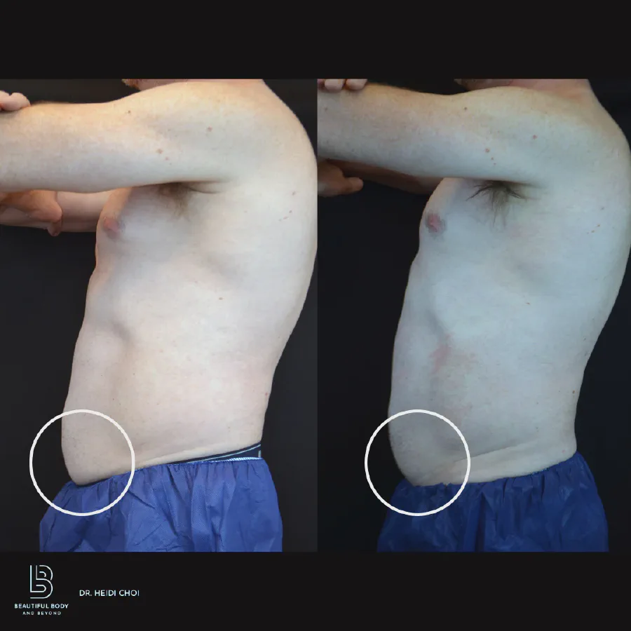 Before and after CoolSculpting Elite on the abdomen and flanks of a male patient treated by Dr. Heidi Choi at Beautiful Body and Beyond