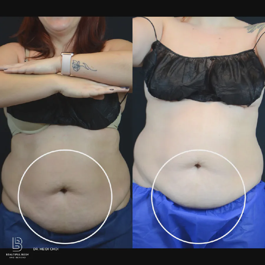 Before and after CoolSculpting Elite on the lower abdomen of a female patient treated by Dr. Heidi Choi at Beautiful Body and Beyond