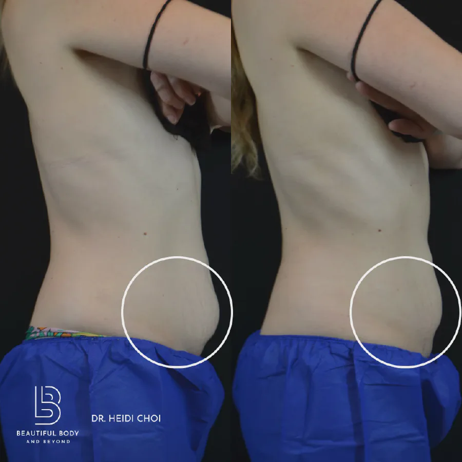 Before and after CoolSculpting Elite on the flanks of a female patient treated by Dr. Heidi Choi at Beautiful Body and Beyond