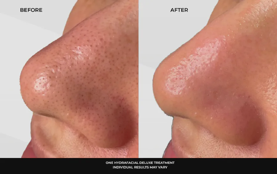 Before and after a single HydraFacial Deluxe treatment showing visibly clearer nose pores, photographed at Beautiful Body and Beyond