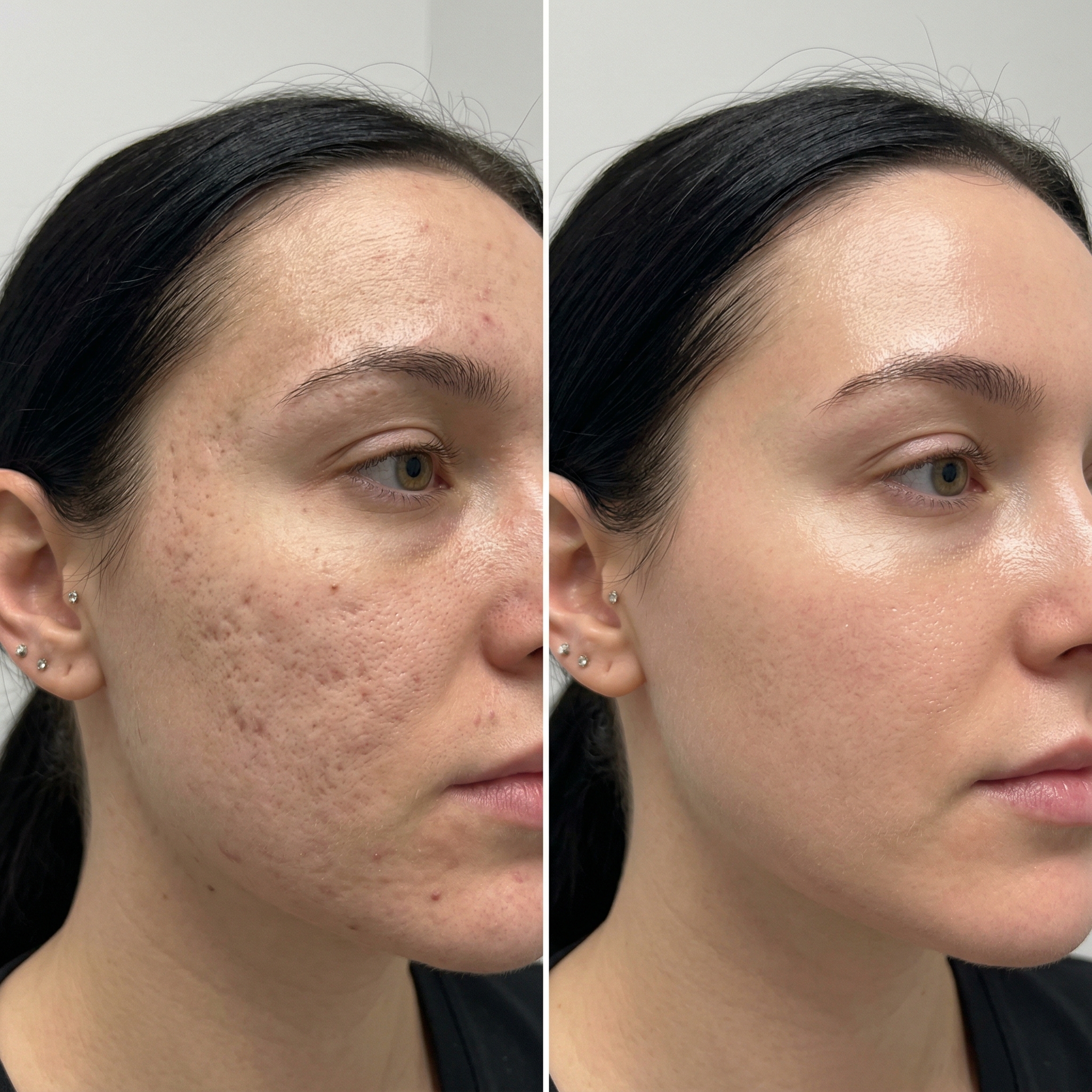 Before and after comparison showing reduced acne scars, smoother skin texture, and improved radiance from microneedling treatment series