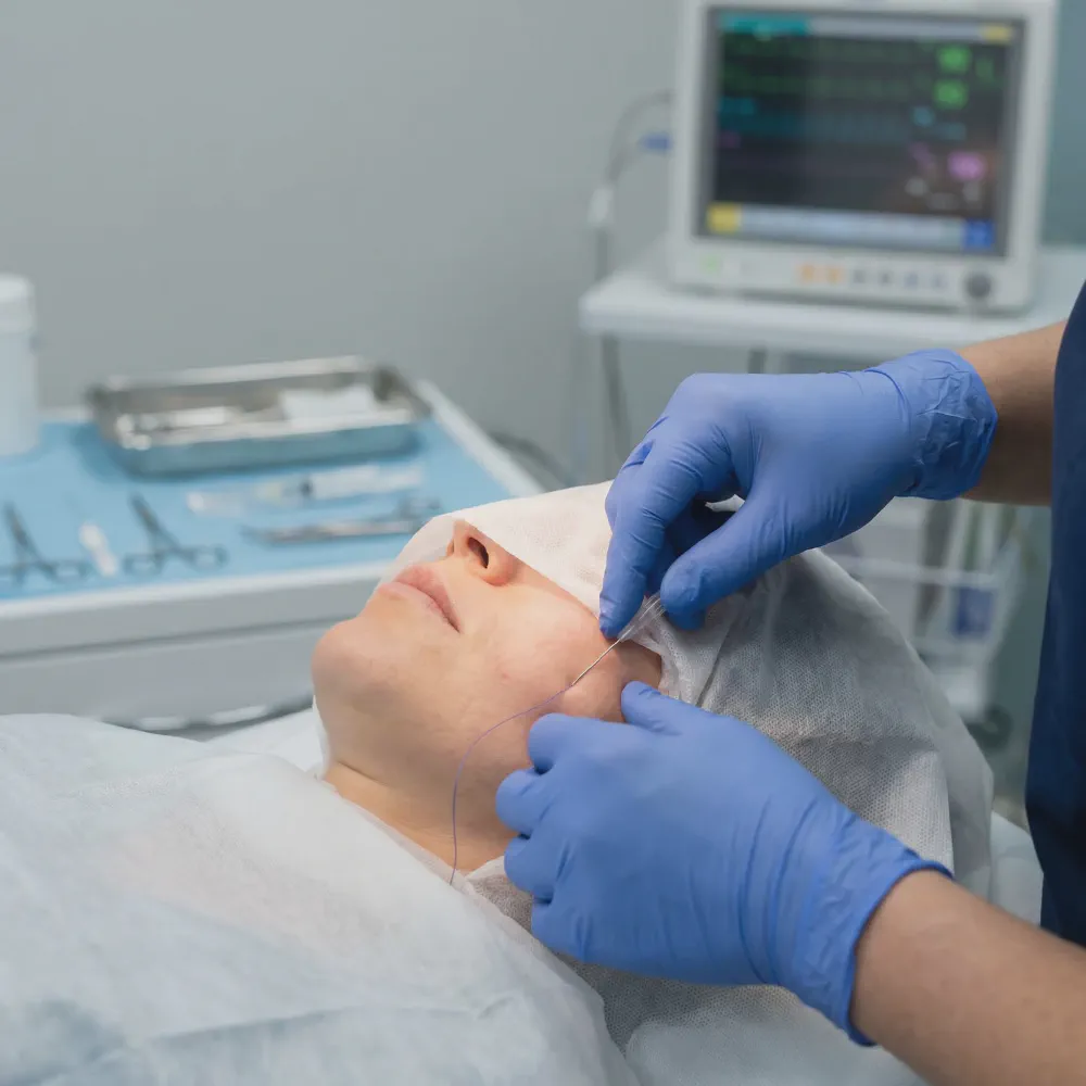 Close-up of a medical professional carefully placing a PDO thread in a patient's cheek area