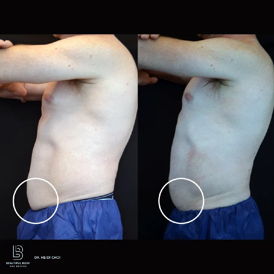 Before and after CoolSculpting Elite on the abdomen and flanks of a male patient treated by Dr. Heidi Choi at Beautiful Body and Beyond