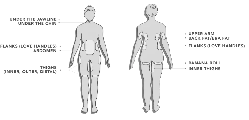 Diagram of the nine CoolSculpting treatment areas: under the chin and jawline, upper arms, bra and back fat, abdomen, flanks, banana roll and inner, outer and distal thighs